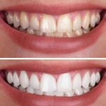 crest whitestrips