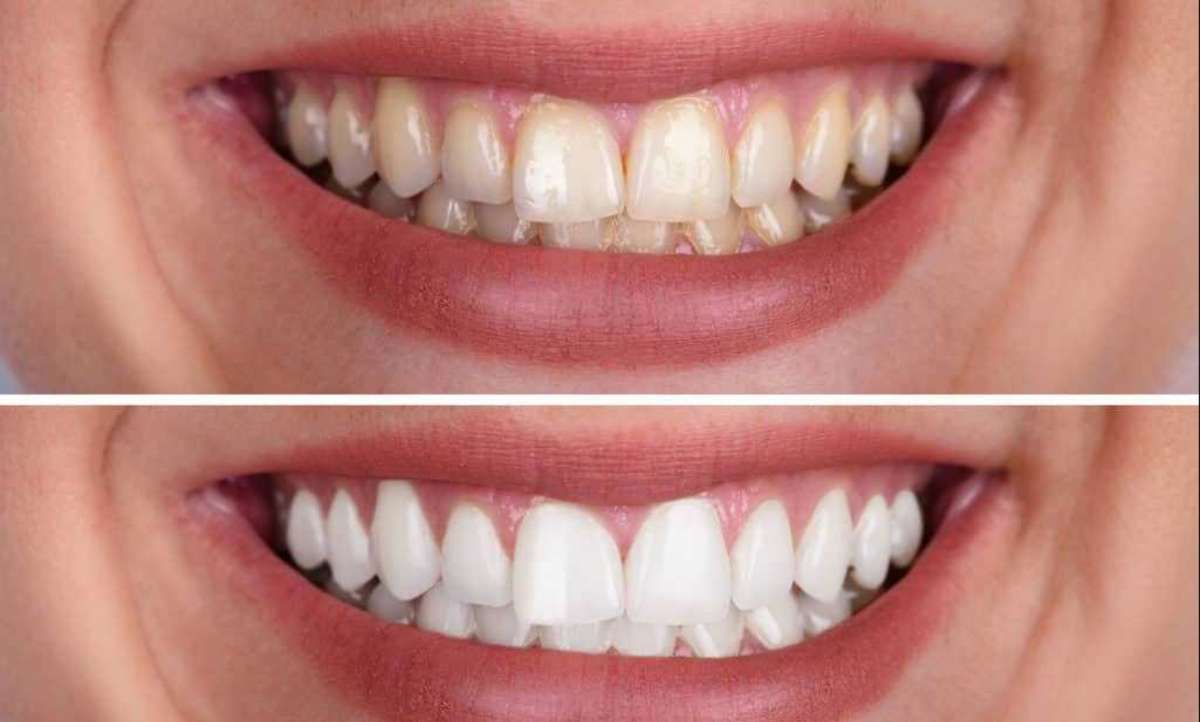 How to Apply Crest Whitestrips For Effective Teeth Whitening