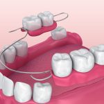 partial dentures near me