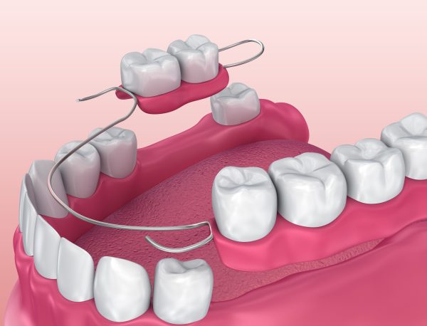 Why Partial Dentures May Be The Right Choice For You?