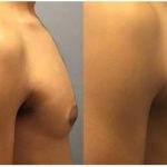 New York city male breast reduction surgery