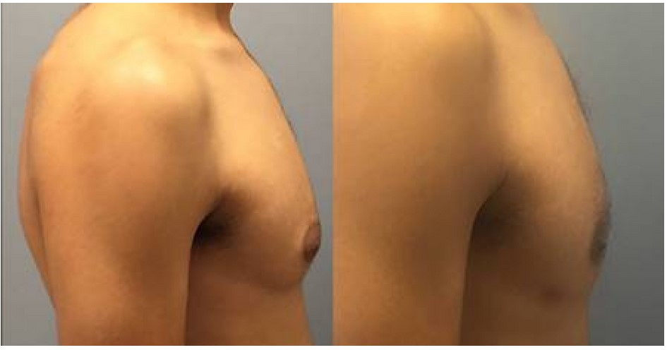 New York city male breast reduction surgery